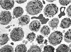 M,32y. | blood - eosinophilic leukemia M,32y. | blood - eosinophilic leukemia